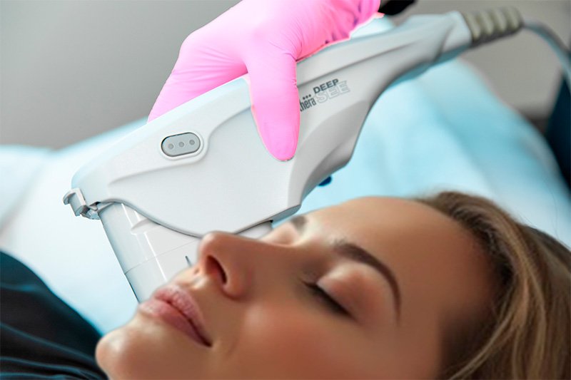 Ultherapy: Natural Lifting Without Surgery